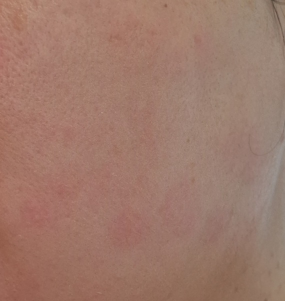 What are these face blotches?
