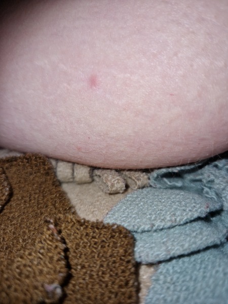 Photo of lump