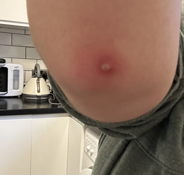 What on earth is this "spot" on my elbow? Pic attached