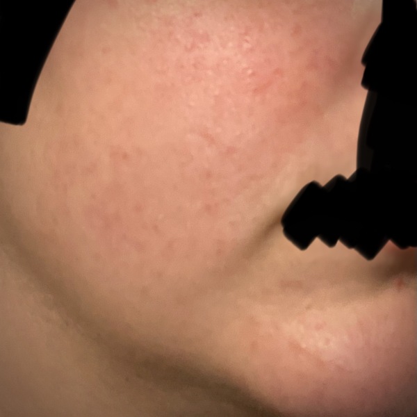 Skincare confusion - help for easily reddening and raised skin!