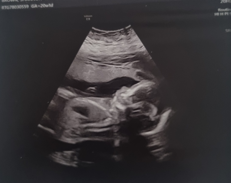 Nub theory - i have my 20 week scan tomorrow