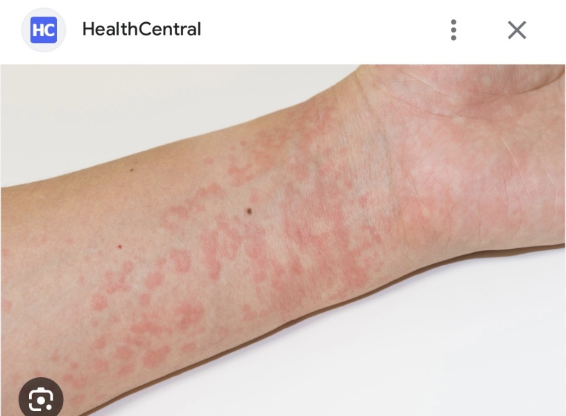 Hives/stress/anxiety