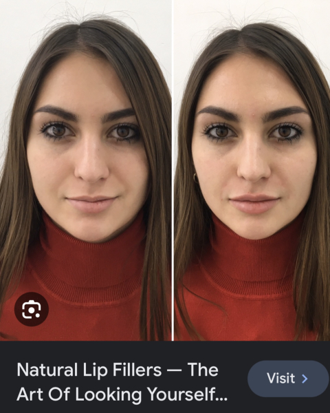 Lip filler everywhere