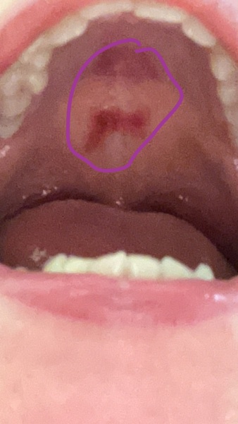 To think this could be measles rash in dd throat.