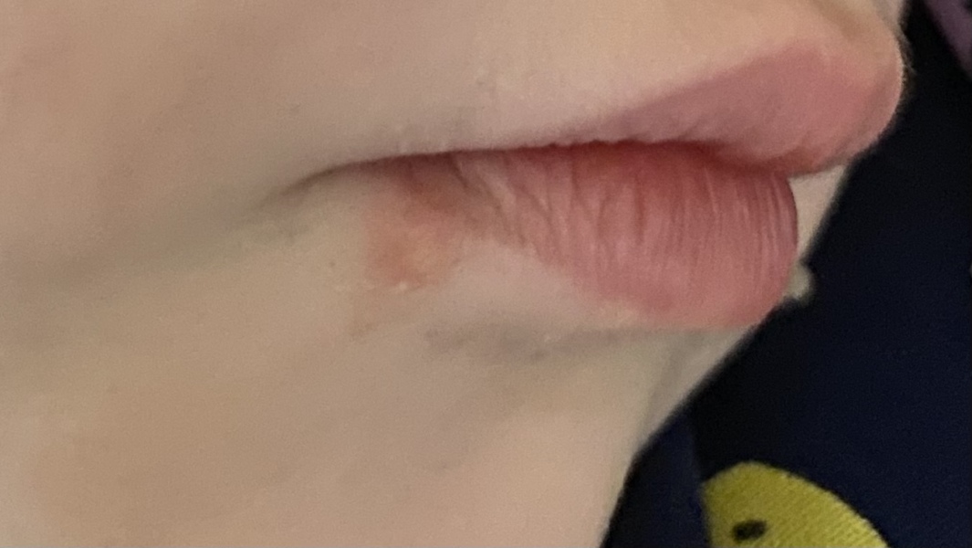 Cold sore?