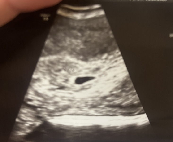 Anyone early scan help