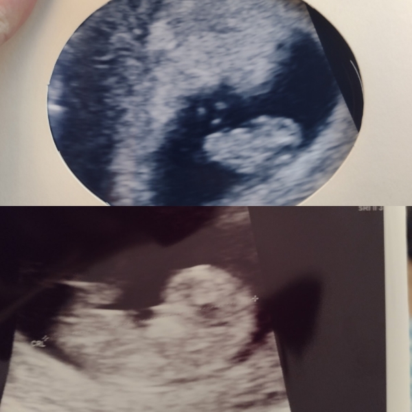 Scans at 8.5-10.5 weeks what could you see ?