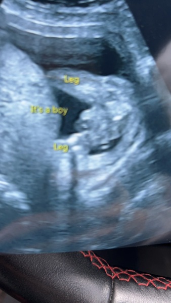 Is this definitely a boy before I tell my family today?