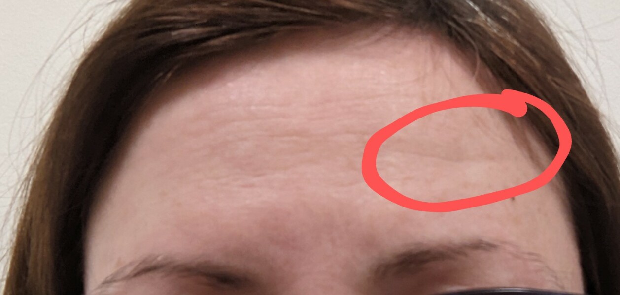 My baby dented her forehead on the skirting board. I am so upset. Pic included.