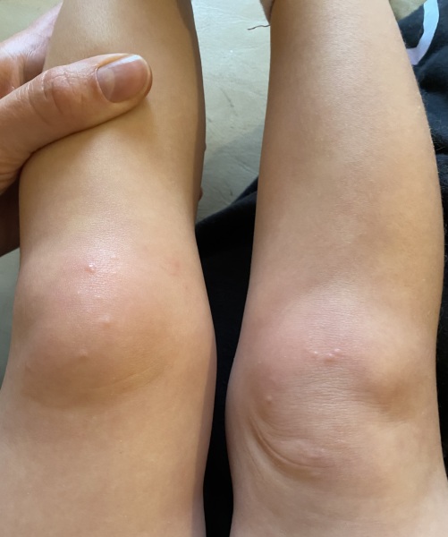 Rash on toddlers knees