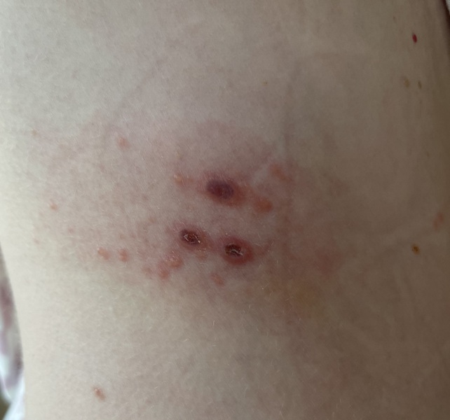 What could have bitten me?