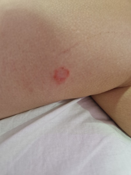 Help.. What are these bites?