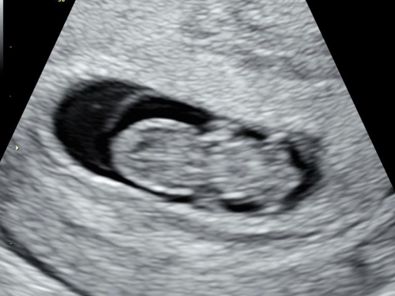 First trimester anxiety misery :(