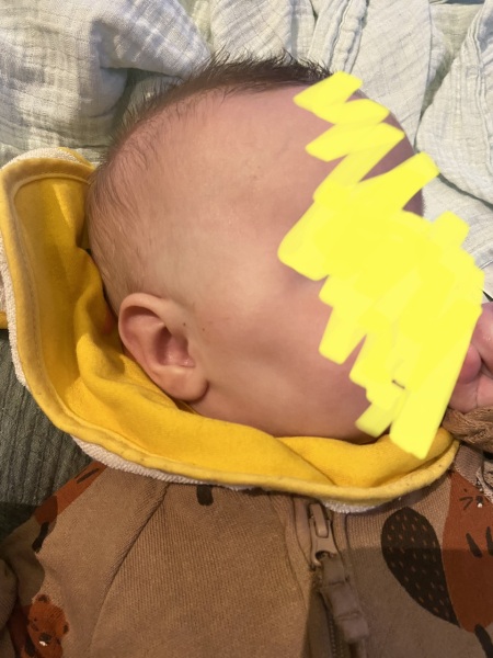 Swelling like lump on 4 month olds face