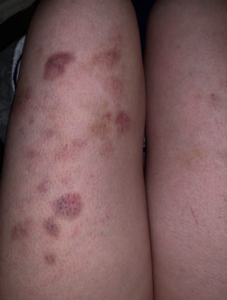 Bruising