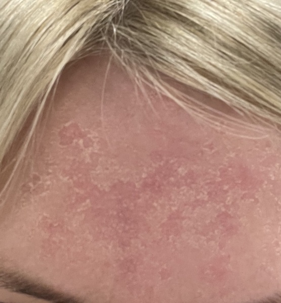 Tretinoin Dermatica