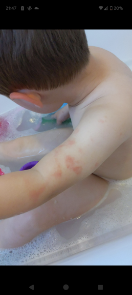 Chicken pox or hand foot and mouth?