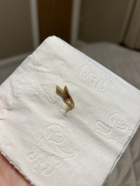 Tissue loss 29 weeks pregnant