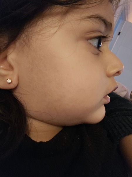 Dry red spotty cheeks on toddler