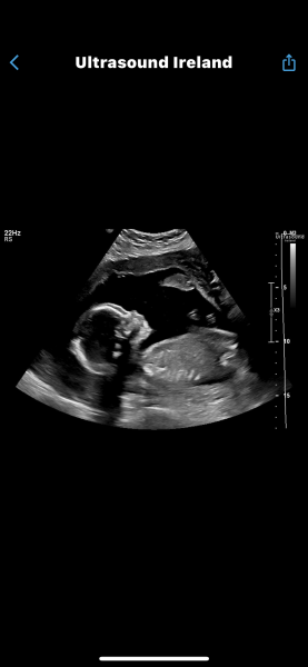 20 week scan boy or girl ?