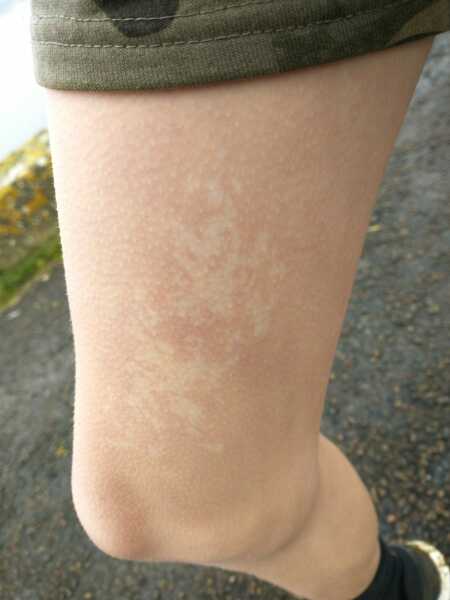 Pattern on child's leg when cold