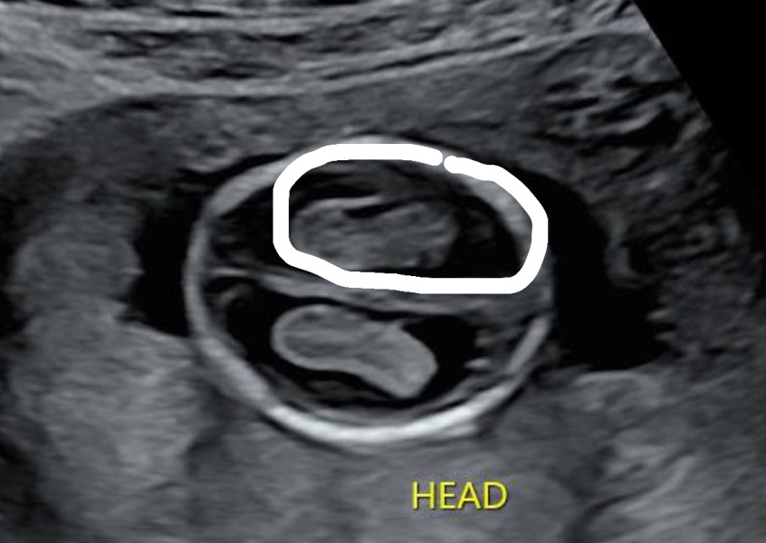 Baby’s brain