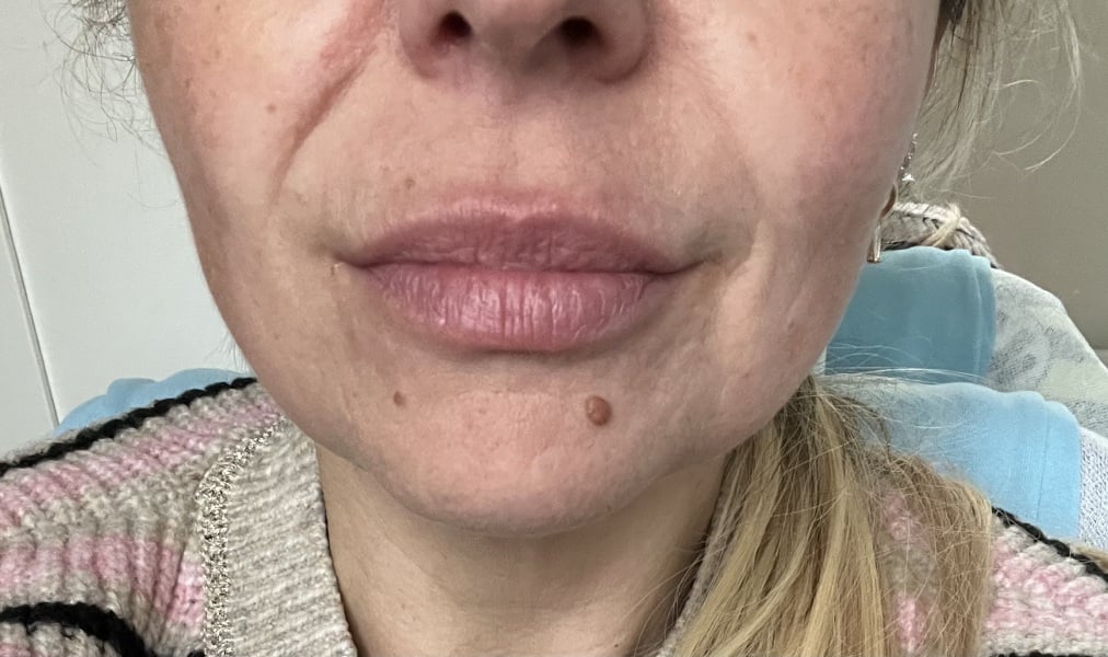 What is with lip fillers?!? They look so fake and awful