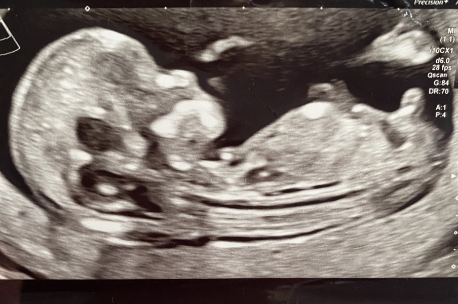 Did anyone have a boy nub on their 12 week scan but end up having a girl?