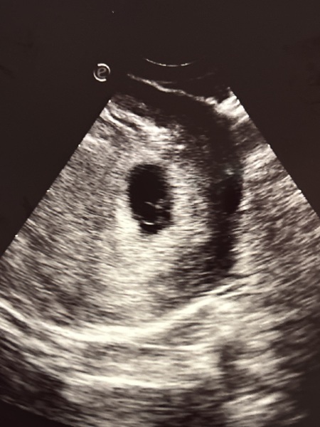 Ultrasound at 5w6days twins?