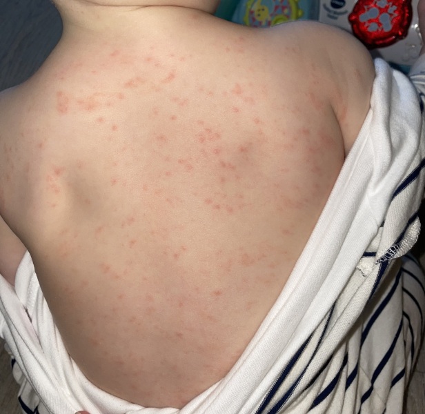 Chicken pox?