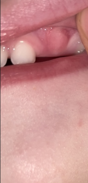 Intermittent temperature