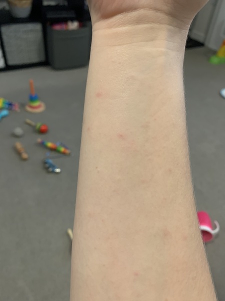 Is this an allergy rash?