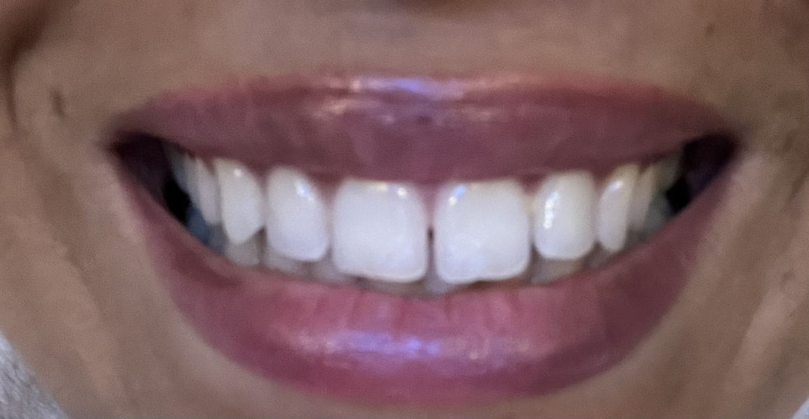 To be upset dentist said this about my teeth (pics included)