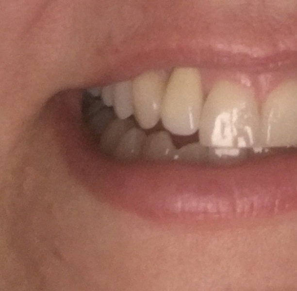 Dental Implant?