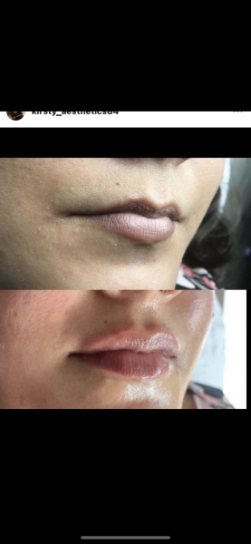 What is with lip fillers?!? They look so fake and awful