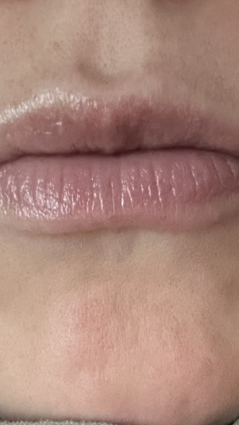 What is with lip fillers?!? They look so fake and awful