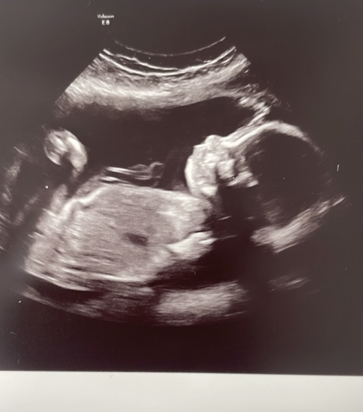 Ultrasound scan