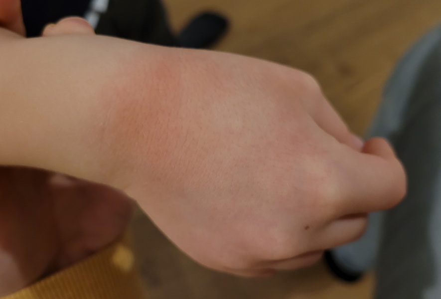 Is this eczema?