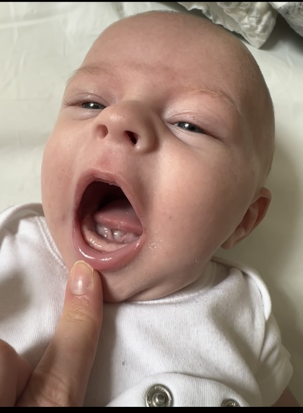 Tongue tie ?