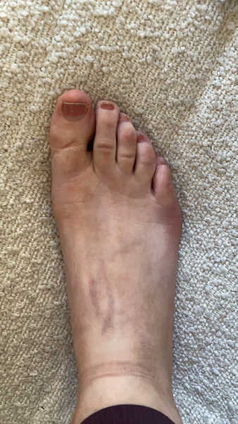 Hurt foot or bunion?
