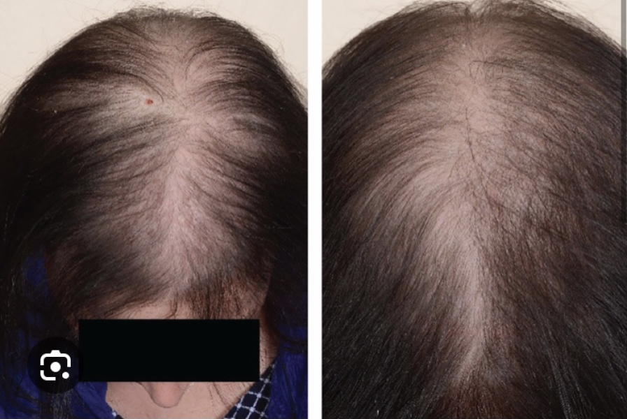 Male pattern hair loss - what are you doing about it ?