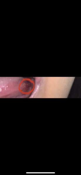Tongue cancer