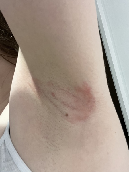 What’s happened to under my arms (photos included)?