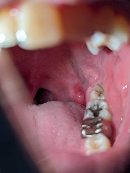 Lump at back of mouth