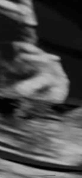 Is there a nasal bone present?