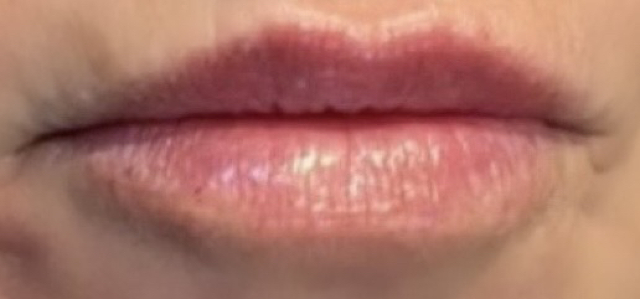 Lip filler everywhere