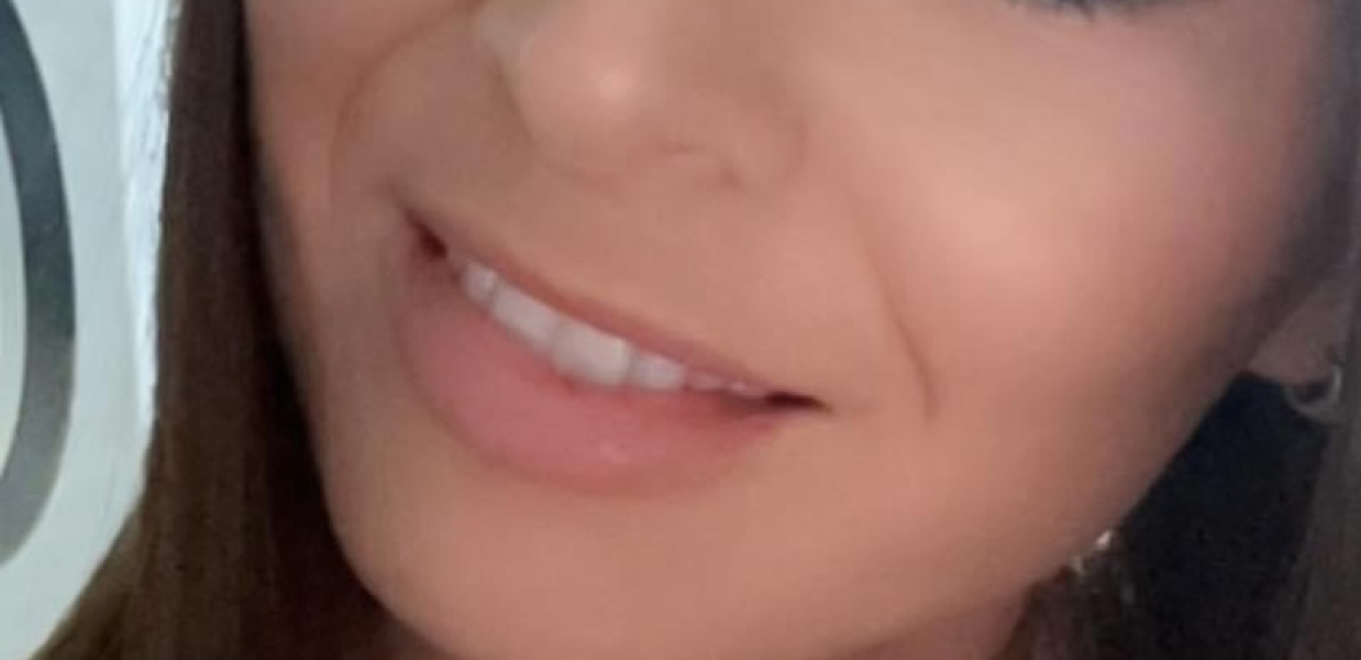 Lip filler everywhere