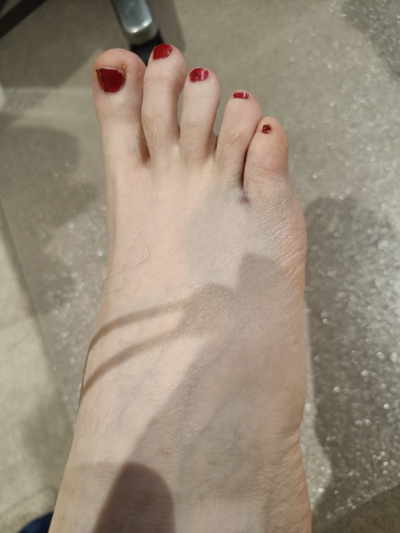 Broken little toe