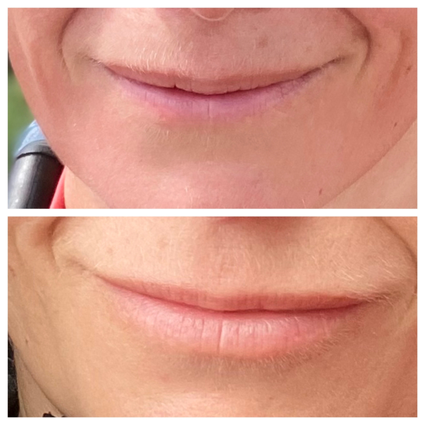 What is with lip fillers?!? They look so fake and awful