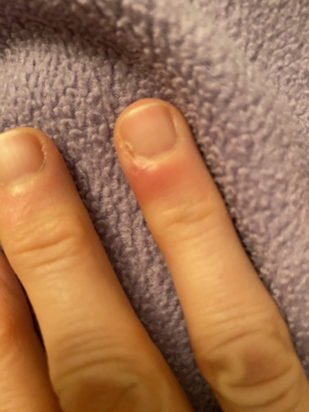 I'm guessing this is infected